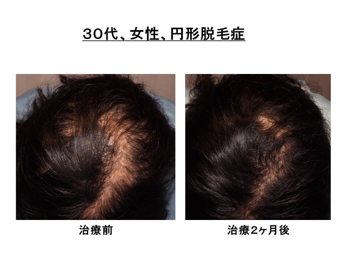 円形脱毛症　病院""
